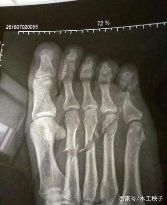 安全常记心中 从一起电锯事故看家庭作业的安全防线